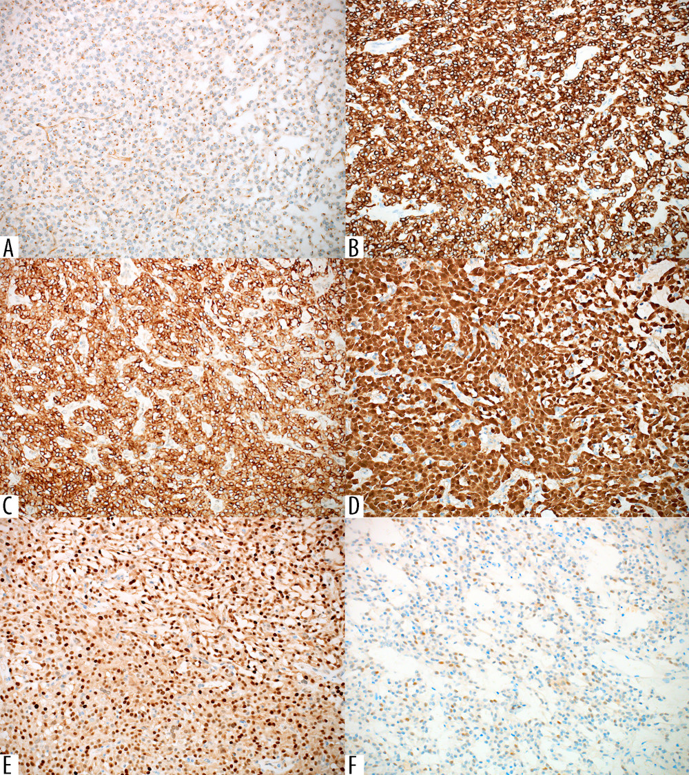 A panel of immunohistochemical stains. (A) CD99 shows a paranuclear dot-like pattern of staining in tumor cells. Tumor cells are positive for (B) CAM 5.2, and (C) CD10. They also show positive nuclear staining for (D) β-Catenin, (E) cyclin D1, and focally for (F) progesterone receptors (immunohistochemical staining, ×200).
