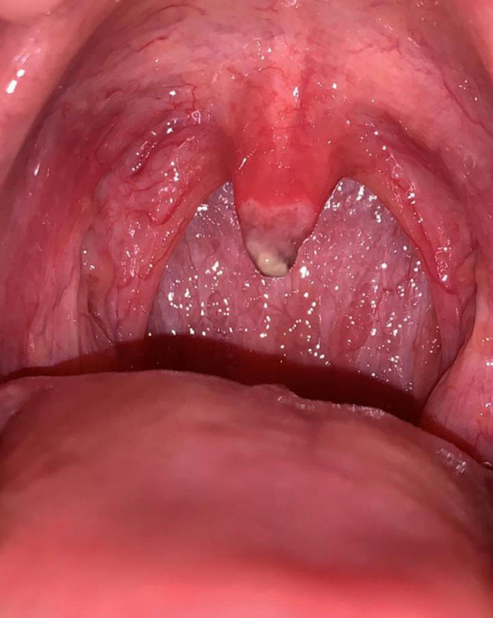 A necrotized uvula with yellow exudate was observed on day 1 after esophagogastroduodenoscopy (EGD).