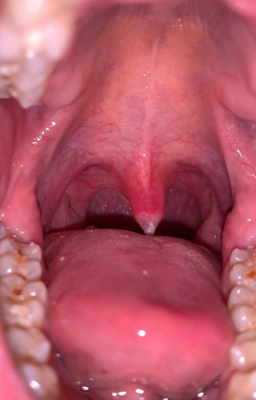 A necrotized uvula with yellow exudate and partially sloughed mucosa was observed on day 4 after EGD.