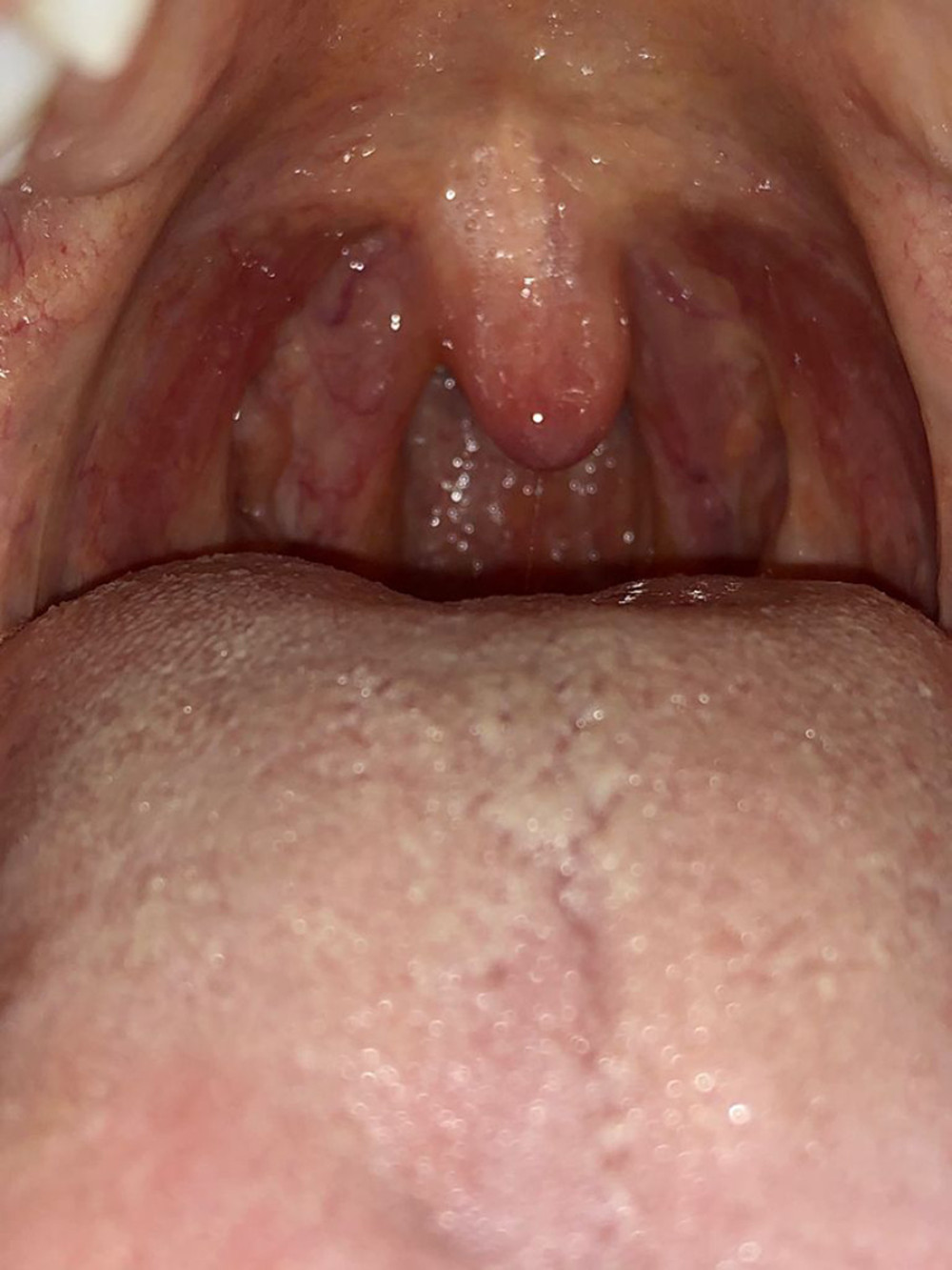 A shortened uvula was observed on day 14 after EGD.