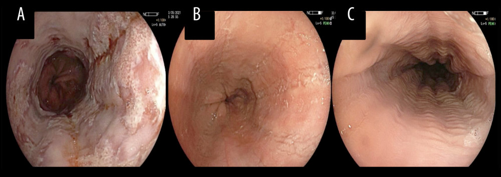 (A) Corresponding to the lower third of the esophagus, showing multiple superficial ulcerations with exudate and geographic borders ascending longitudinally from the distal esophagus. (B) Lower third esophagus showing some unstructured circumferential grooves. (C) Corresponding to the middle esophageal mucosa, evidencing trachealization of the mucosa.