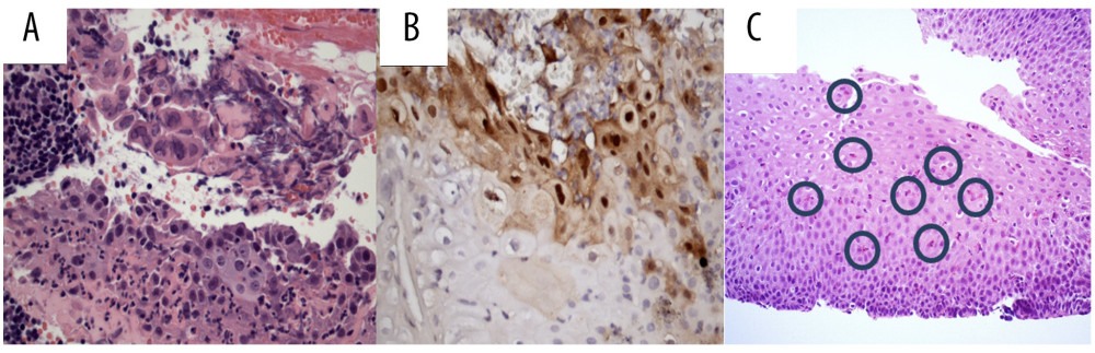 Distal esophagus biopsies showing: (A) eroded mucosa with viral cytopathic changes characterized by multinucleation, nuclear casting, and ground-glass nuclei (HE, 400×) and (B) positive nuclei in immunohistochemical staining for HSV (400×). (C) Middle esophageal biopsy showing squamous esophageal epithelium with numerous intraepithelial eosinophils more than 20 per high-power field, some indicated with circles, HE 200×.