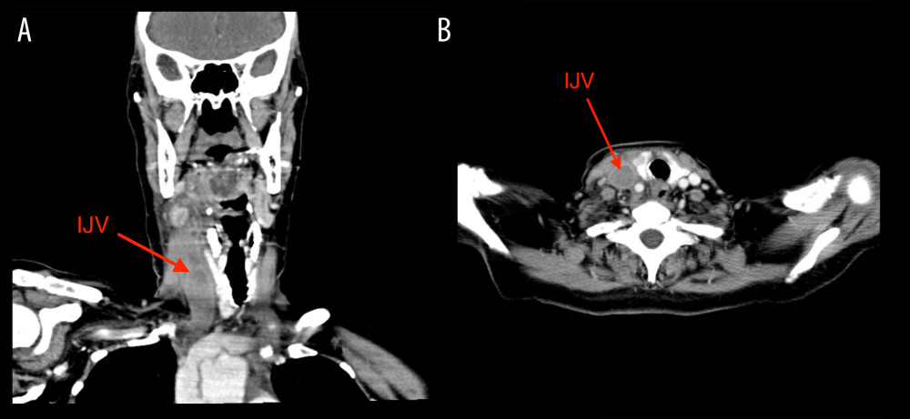 (A) CT imaging of complete thrombosis of the right internal jugular vein. Coronal images from CT neck with i.v. contrast showing complete thrombosis of the right internal jugular vein (IJV) (red arrows). There is also significant edema on the right side of the neck causing a leftward shift of neck structures. (B) CT imaging of complete thrombosis of the right internal jugular vein. Axial images from CT neck with i.v. contrast showing complete thrombosis of the right internal jugular vein (IJV) (red arrows).