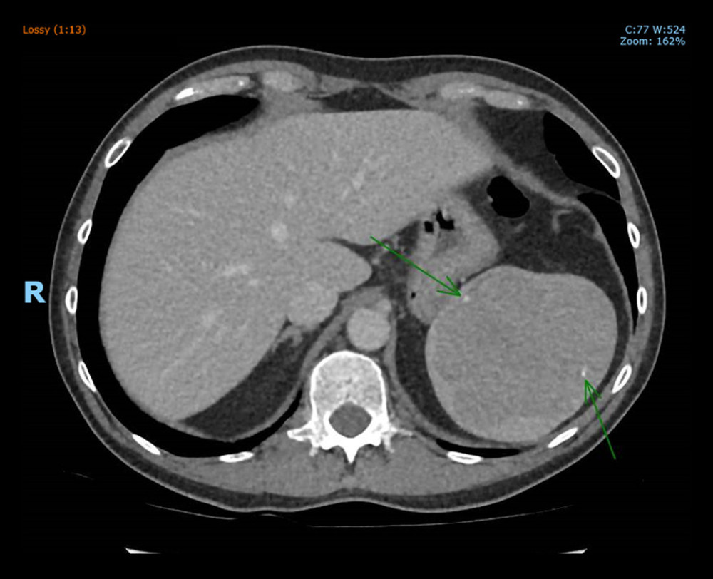 CT abdomen and pelvis with contrast (axial view). A relatively well-circumscribed homogenously low-density mass centered within superior pole of the spleen. Little spicules of calcification are seen in the periphery.