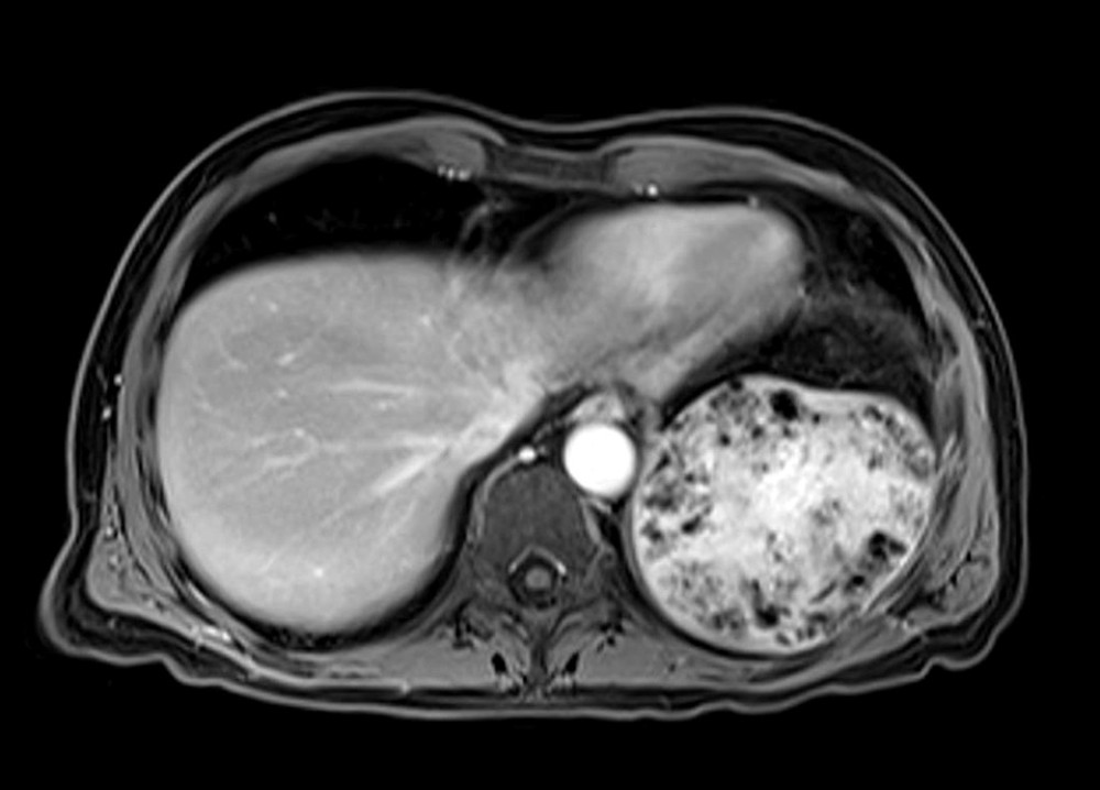 MRI abdomen (T1 sequence). Enhancement of central scar tissue with many hemosiderin nodules scattered throughout, predominantly in the periphery. The lesion contains scar tissue and hemosiderin nodules and has a relatively organized architecture.