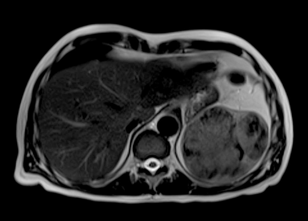 MRI abdomen (T2 sequence). Lesion of interest showing an organized rim of hemosiderin with parallel, almost medullary lines that radiate to the middle.