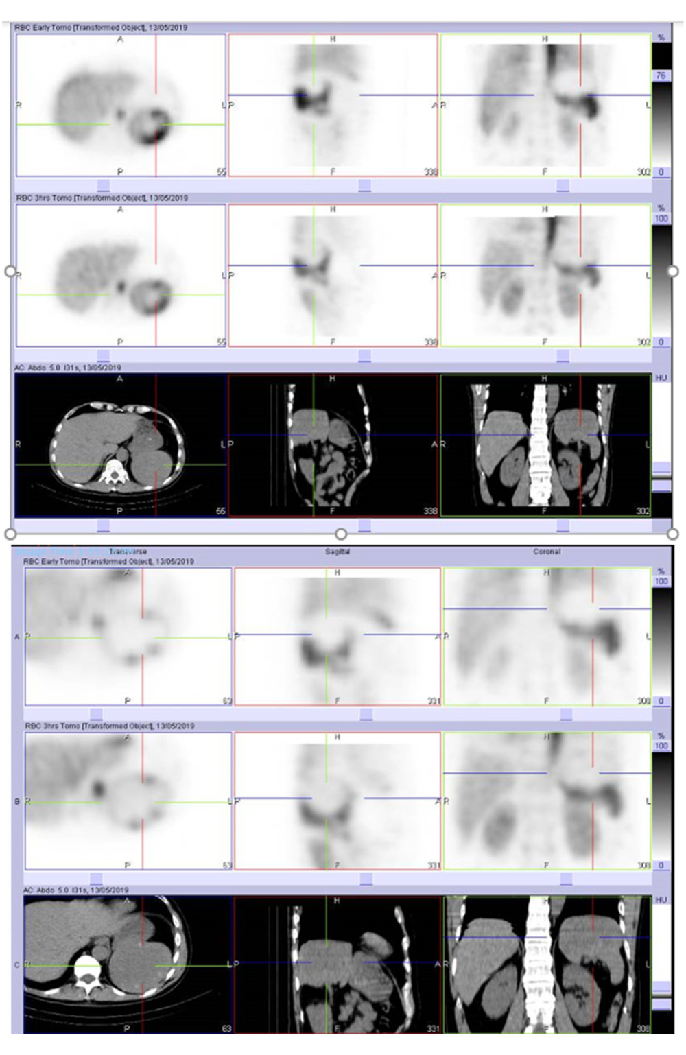 Red cell scan. Large and relatively avascular lesion within the spleen, which only shows minor “filling-in” on delayed imaging.