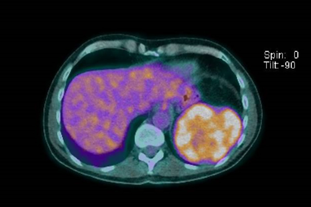 PET-FDG scan. The large splenic mass showed mild heterogenous FDG uptake (SUV-max 5.4).