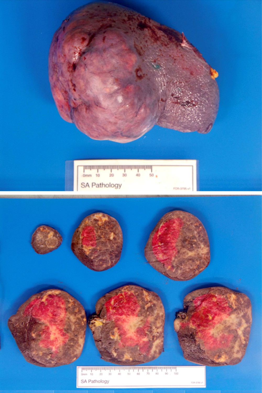 An 80-mm bosselated lesion was seen in the superior pole of the spleen, with intact overlying capsule. The cut surface showed a well-demarcated but encapsulated nodular lesion with areas of sclerosis.