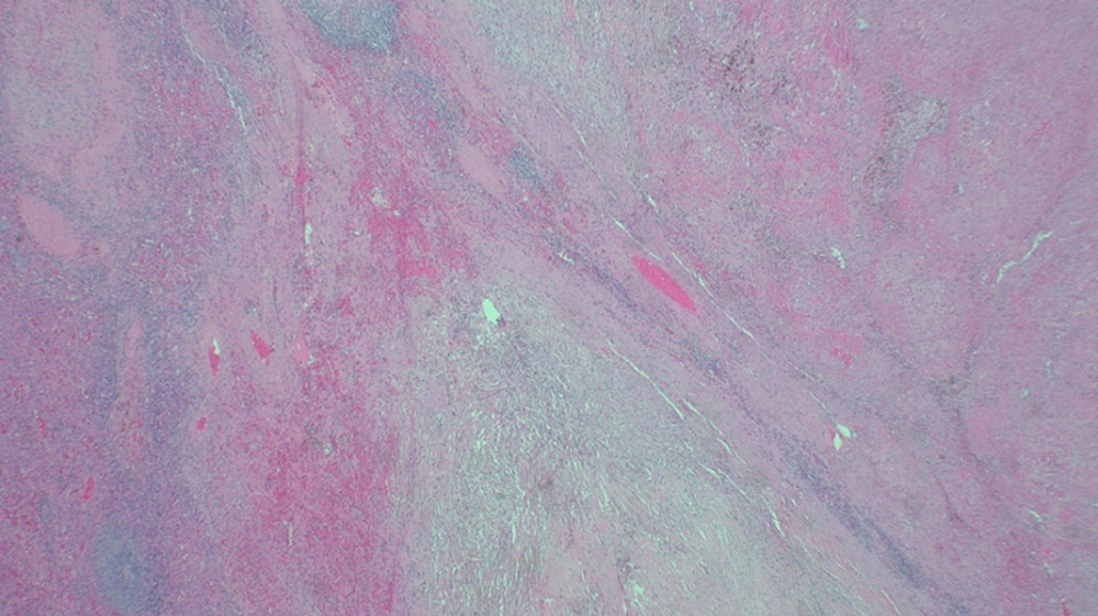 The lesion appeared nodular, with areas of sclerosis, numerous small compressed vessels with adjacent red cell extravasation and hemosiderin deposition, and a background of bland myofibroblasts and chronic inflammatory cells.