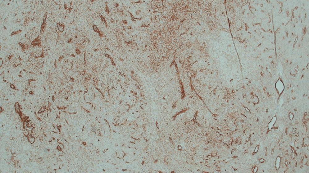 CD 31 immunohistochemistry highlighted the compressed capillary vessels present.
