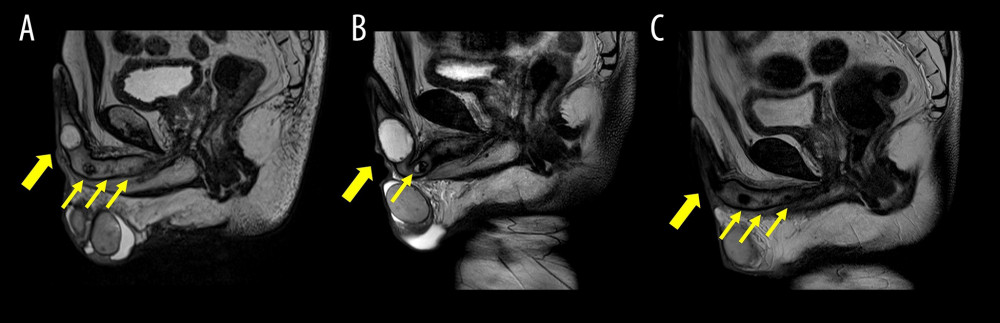 Magnetic resonance imaging of the penile abscess: (A) At the first visit. Fluid that was hyperintense in T2-weighted imaging (T2WI) was collected in the corpus cavernosum. Apart from the main abscess (thick arrow), multiple small lesions (thin arrow) were also observed. (B) Four months after puncture, there was recurrence of abscess. (C) Fifteen months after prednisolone administration, the abscess became a scar that was hypointense in T2WI, and no recurrence was observed.