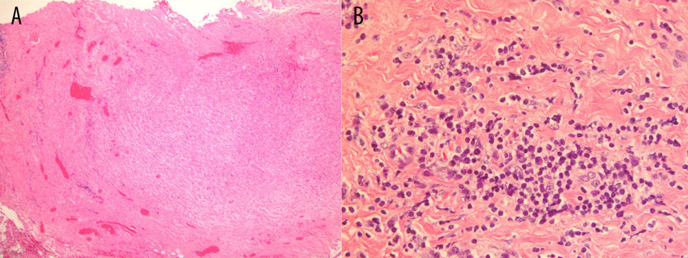 Histopathological image of the penile abscess wall (hematoxylin and eosin staining): (A) Granulation tissue and inflammatory cell infiltration were observed; 40×. (B) Infiltration of inflammatory cells comprised of lymphocytes, plasma cells, and macrophages; very few neutrophils were identified; 200×.
