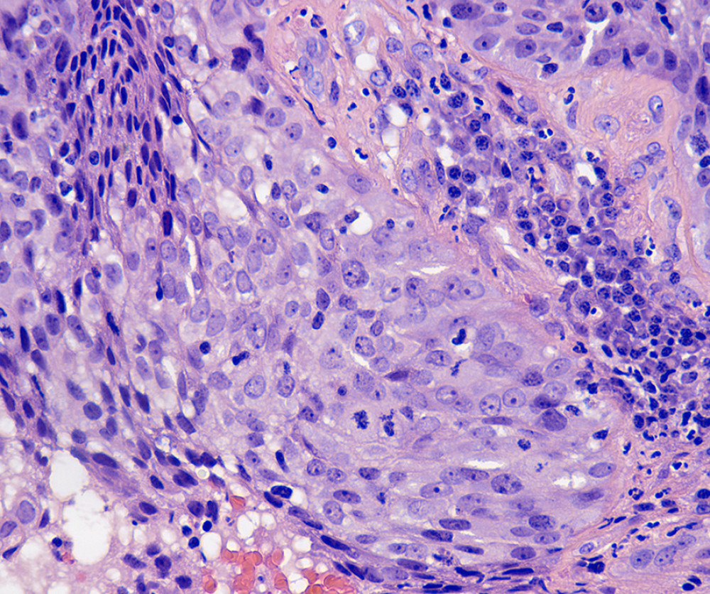 Squamous cell carcinoma of the cervix, nonkeratinizing carcinoma. Hematoxylin and eosin staining (original magnification ×400) high-power microscopic view showing malignant cells with irregular, large nuclei containing multiple nucleoli and cells with abundant eosinophilic cytoplasm.