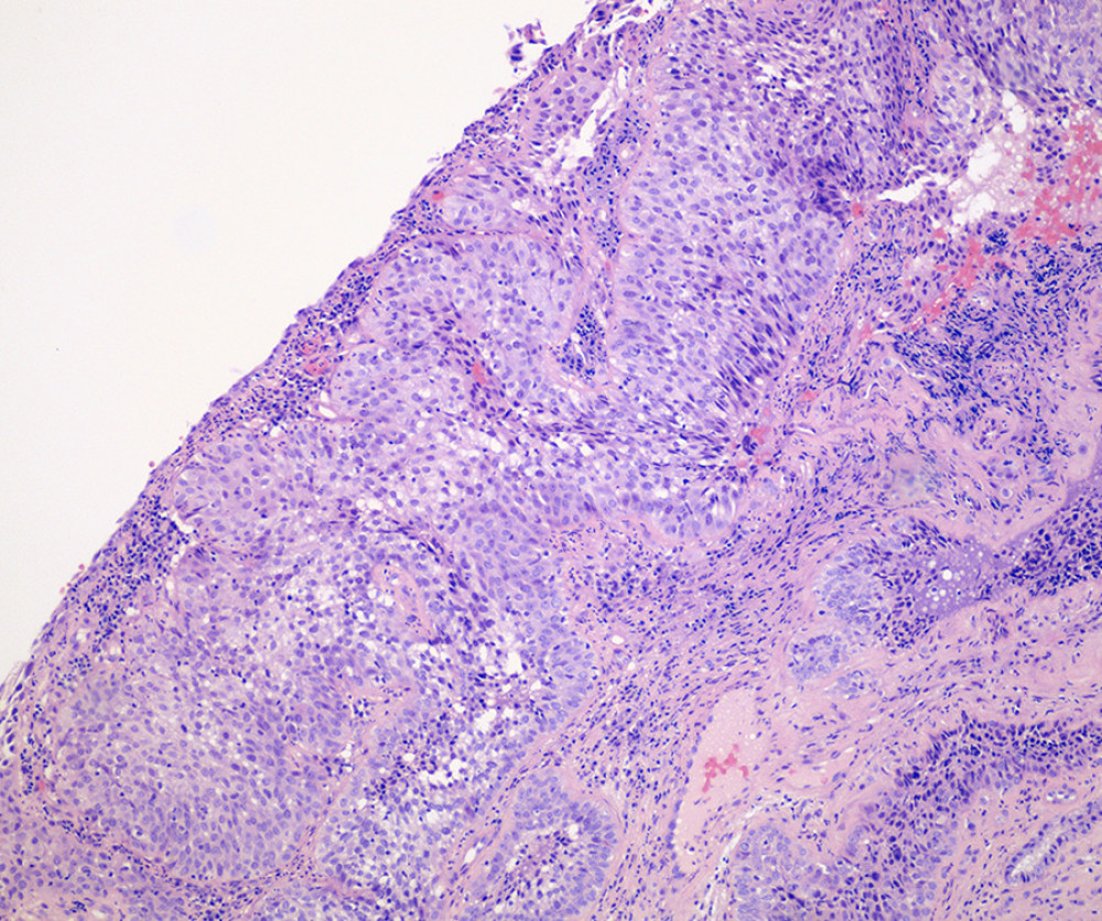 Squamous cell carcinoma of the cervix, nonkeratinizing carcinoma with invasion. Hematoxylin and eosin staining (original magnification ×40) low-power microscopic view showing malignant cells infiltrating as nests. The cytoplasm is moderate and eosinophilic. Large nuclei with multiple nucleoli are prominent.