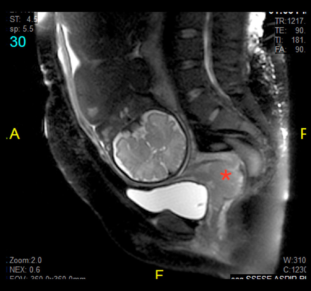 A sagittal magnetic resonance imaging of the abdomen and pelvis. This sagittal view magnetic resonance image of the patient’s abdomen and pelvis shows a fetus in a cephalic presentation with a clear and measurable tumor (red asterisk) involving the anterior lip of the cervix. The mass measured 5.2×5.8 cm; biopsy revealed a moderately differentiated squamous cell carcinoma of the cervix.