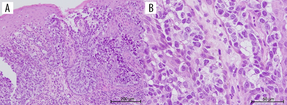 Hematoxylin and eosin staining of the left labia minora specimen. (A) Atypical cells spread throughout the epithelium (objective magnification, ×10). (B) Many Paget cells were characterized by large nuclei, prominent nucleoli, and abundant pale cytoplasm (objective magnification, ×40).