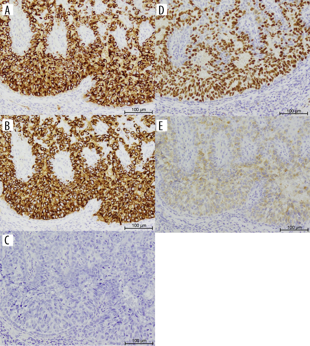 Immunohistochemical staining of the left labia minora specimen (objective magnification, ×20). (A) Positive for cytokeratin 7. (B) Positive for cytokeratin 20. (C) Negative for gross cystic disease fluid protein 15. (D) Positive for GATA3. (E) Positive for uroplakin II.