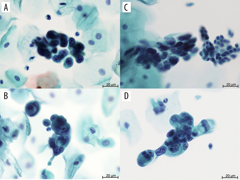 Cytological findings with Papanicolaou staining from each region (objective magnification, ×40): (A, B) cervix, (C) endometrium, and (D) urethral meatus. The findings were similar and showed clusters of atypical cells with high nuclear/ cytoplasm ratio, irregular nuclear membranes, and prominent nucleoli.
