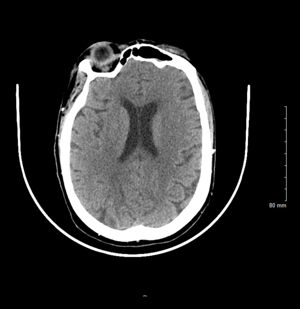 Computed tomography (CT) scan of the head done on the day of admission, showing age-related diffuse cerebral and cerebral volume loss.