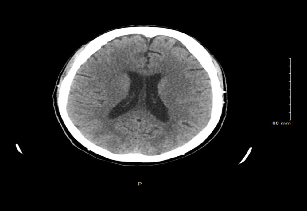 Repeat computed tomography (CT) scan of the head 7 days later, showing no interval changes.