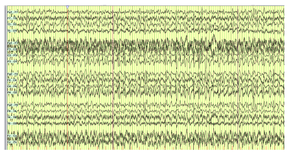 EEG showing epileptiform discharges, synchronous and asynchronous, with amplitude predominance mainly in the frontal, central parietal, and occipital regions.