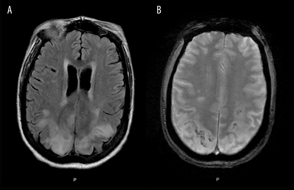 MRI Brain on day 15 of admission showing abnormal FLAIR (A) and T2-weighted (B) signals of the parieto-occipital and high bilateral fronto-parietal lobes, predominantly in the white matter. The signal abnormality is largely bilateral and symmetrical. Findings are suggestive of posterior reversible encephalopathy syndrome (PRES).