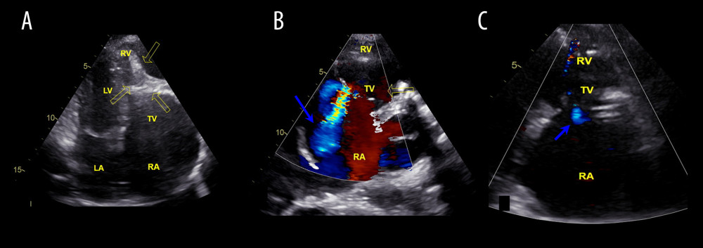 Echocardiograms of the patient before (A, B) and after surgery (C). (A) Echocardiography, 4-chamber plane. Arrows indicate endomyocardial fibrosis of the ventricle with areas of calcification. (B) Illustration of pronounced regurgitation of the TC (the blue arrow). (C) Shows minimal regurgitation on the TV after valvulo-annuloplasty (the blue arrow). LA – left atrium; RA – right atrium; TV – tricuspid valve; LV – left ventricle; RV – right ventricle.