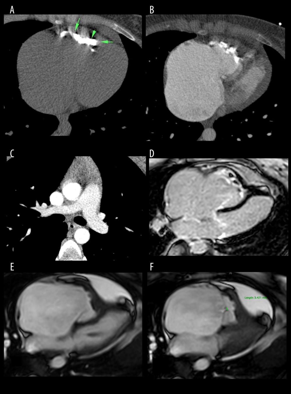 Multi-spiral computed tomography of the chest organs (axial plane) (A–C). Magnetic resonance imaging of the heart (4-chamber plane) (D–F). (A) “Native” series: arrows indicate massive calcification in the ventricular cavity; (B, C) – series with contrast enhancement: (B) The cavity of the ventricle is reduced in size due to obliteration of the trabecular part; (C) No signs of thromboembolism and areas of calcification at the site of pulmonary. (D) Delayed contrasting (LGE). (E) Phase of diastole; (F) Phase of systole.