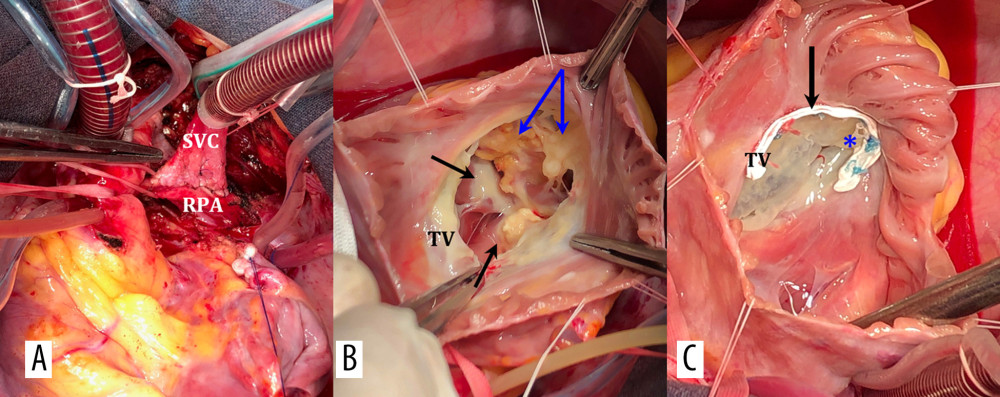 Intraoperative photographs. (A) Bidirectional cavopulmonary anastomosis (B) Visualization of TV: dilatation of fibrous anulus, thin leaflets, black arrows indicate fibrosis and calcification of papillary muscles, blue – calcification of the ventricle wall. (C) Annuloplasty of TV on a soft PTFE half-ring, valvuloplasty RV, U-shaped Prolene suture along the anteroposterior commissure. SVC – superior vena cava; RPA – right pulmonary artery; TV – tricuspid valve; FA – fibrosus annulus; RV – right ventricle.