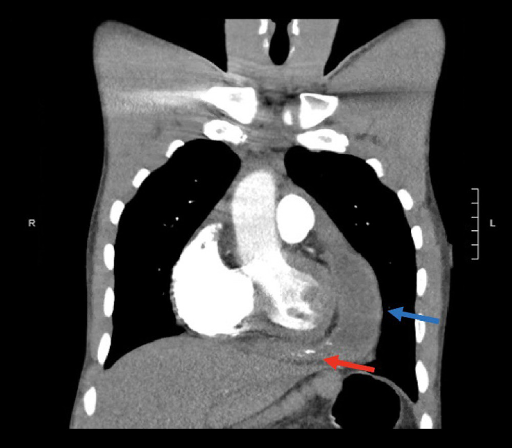 Chest CTA during first hospital admission demonstrating a pericardial effusion (blue arrow) and irregular pericardial thickening with multifocal calcification (red arrow).