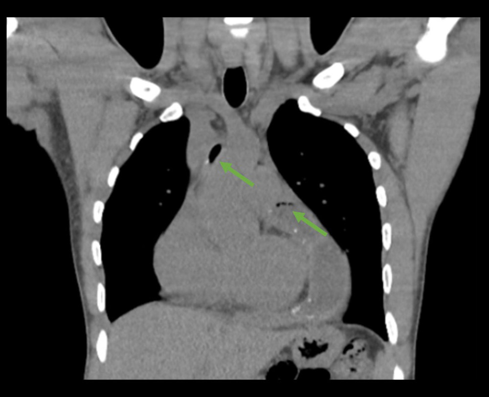 Chest CT during outpatient evaluation demonstrating interval development of associated locules of air (green arrows).
