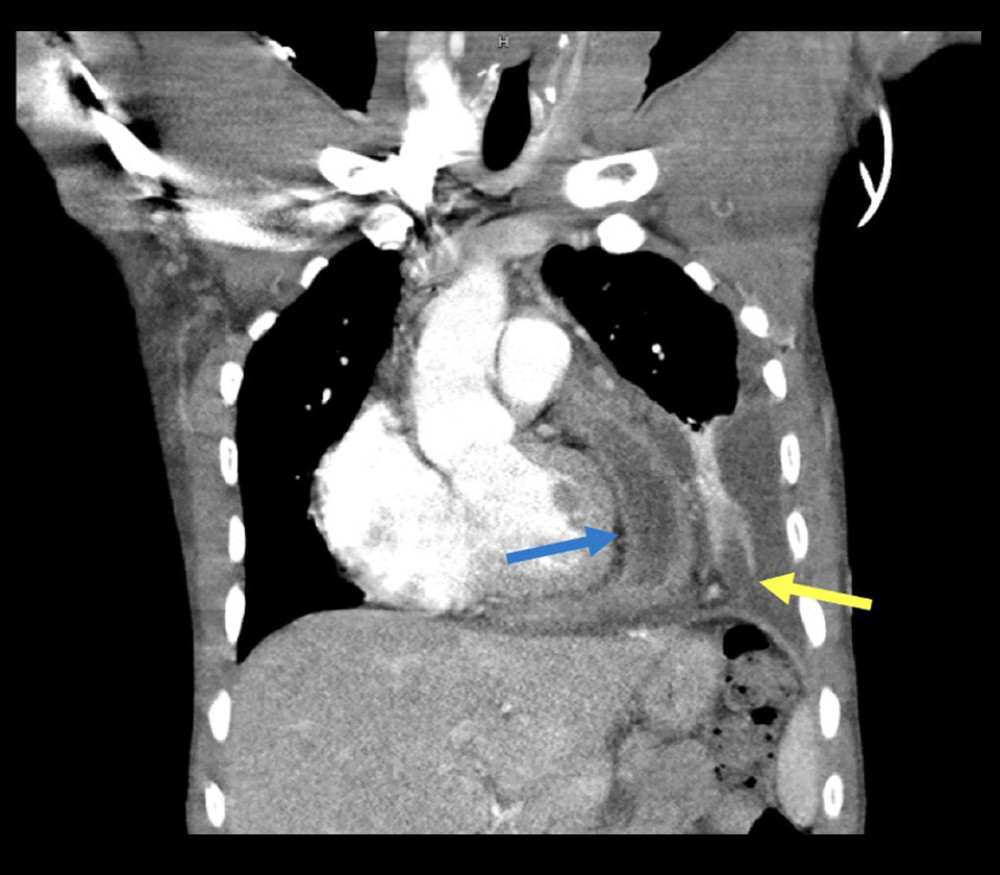 Chest CT during third hospitalization demonstrating a complex pericardial fluid collection (blue arrow) and a large left pleural effusion with underlying parenchymal consolidation (yellow arrow).