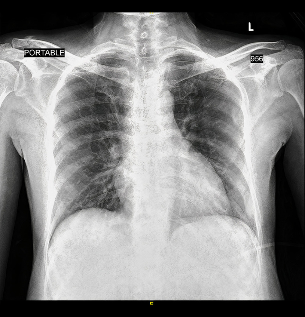 AP view CXR on the day of admission shows normal lung fields, clear bilaterally, costophrenic angle. No evidence of pneumonia. On the day of admission (8 April 2021).