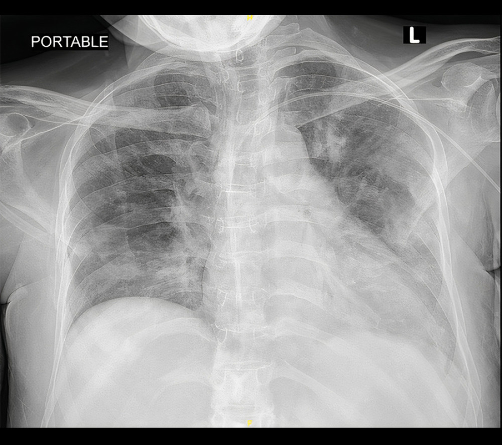 AP view CXR on day of respiratory deterioration and intubation shows patchy infiltration involving the upper left radiological zone and multiple patches over the whole right lung field with lobar infiltration of middle and lower left radiological zone obliterating the left costophrenic angle. On day of intubation (30 April 2021).