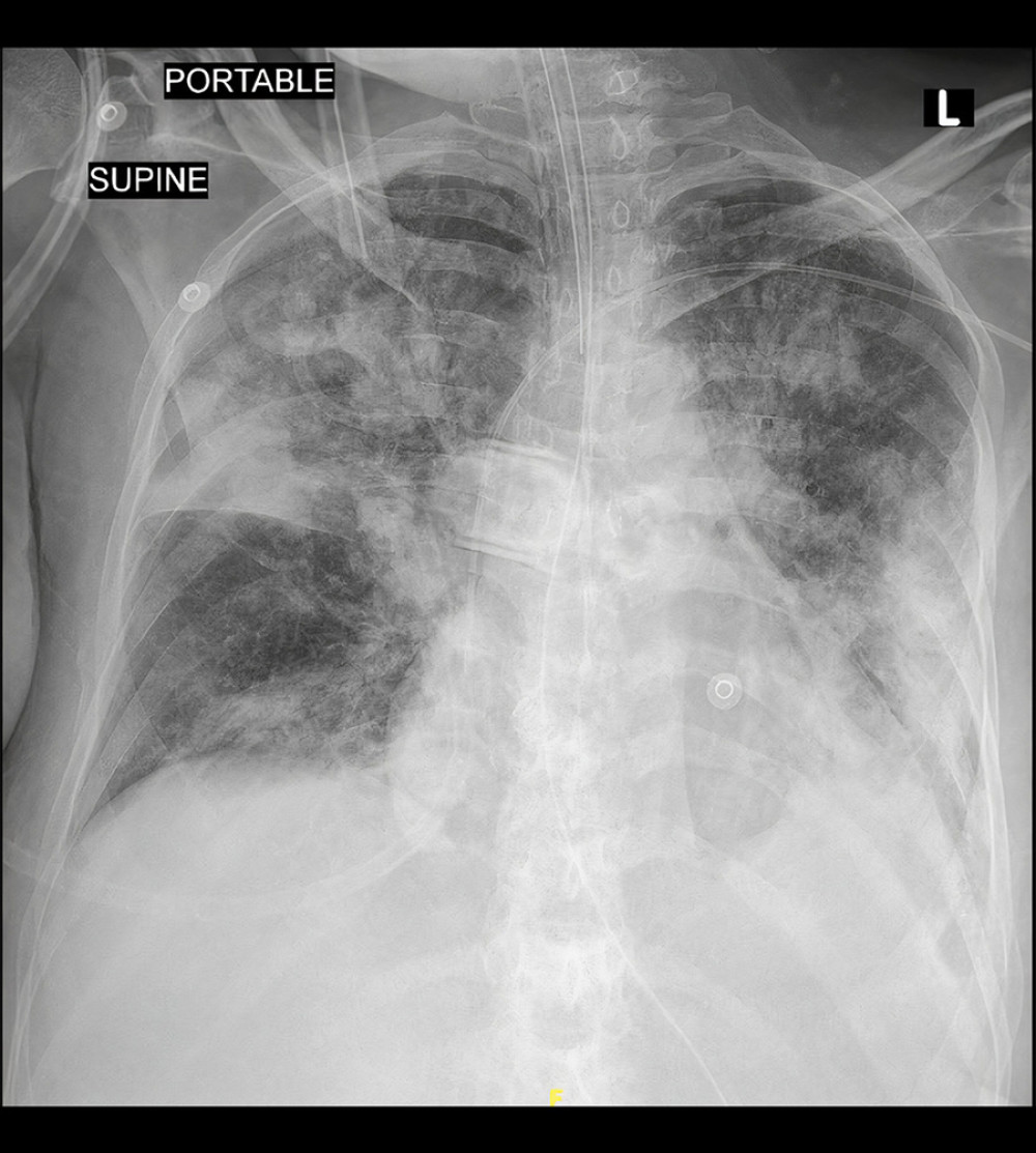 AP view CXR day 2 after intubation shows severe pneumonia with bilateral infiltration involving the middle and lower zone of the left lung and right upper zone one. Image taken on 2 May 2021.