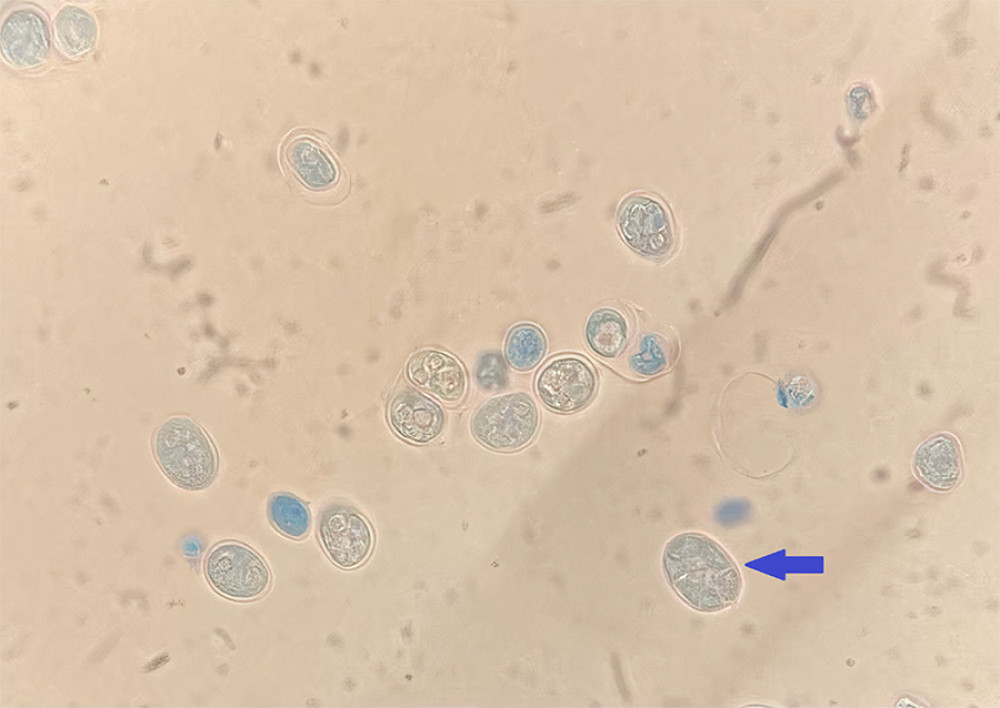 Appearance of sporangiospores in Lactophenol cotton blue microscopic visualization: Lactophenol cotton blue wet mount microscopic examination, 40×, from transtracheal culture, shows multiple cells, globose to ovoid in shape, varying in size, and from 4–6 sporangiospores (blue arrow) contain in each cell. Image taken on 2 May 2021.