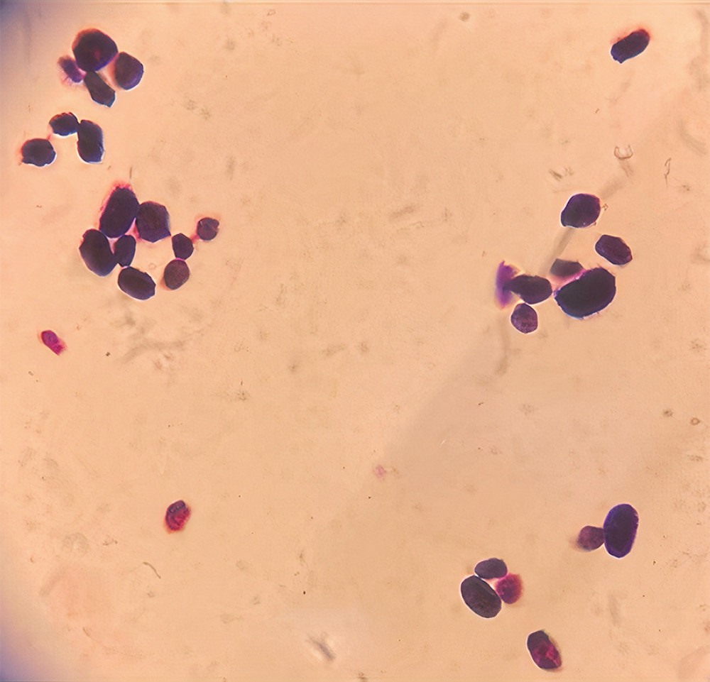 Appearance in gram stain of P. zopfii from blood agar: Gram stain of colony from blood agar, seen under 100×, from blood culture, shows gram-positive yeast-like no budding, the sporangiospores not seen by gram stain. Image taken on 2 May 2021.