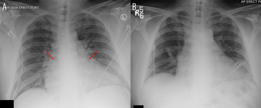(A) Initial chest X-ray, demonstrating subtle, but well-circumscribed, opacity underlying the cardiac silhouette (red arrows). (B) Postoperative chest X-ray without the density.