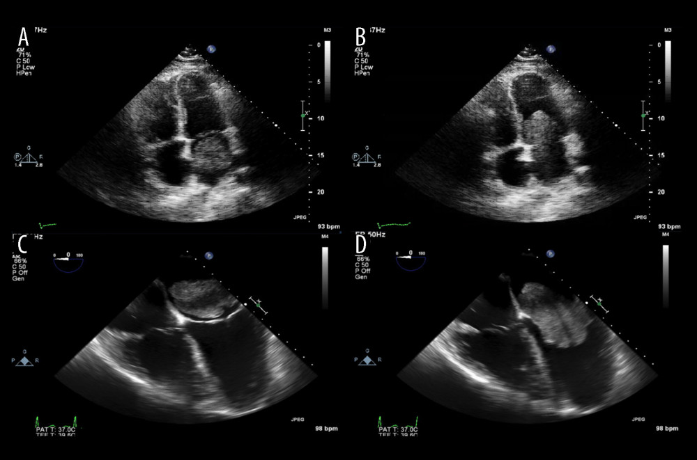 (A, B) Initial transthoracic echocardiogram demonstrating a large left atrial mass (9×4 cm) prolapsing into the left ventricle. Right ventricular systolic pressure was 95 mmHg. (C, D) Perioperative transesophageal echocardiogram demonstrating a 7.5×4.5 cm mass attached to the atrial septum. Left ventricular ejection fraction was 40–45%.