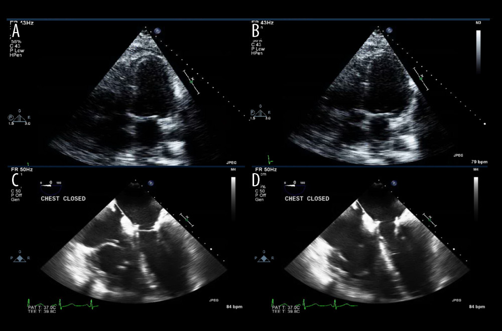 (A, B) Postoperative transthoracic echocardiogram showing that the mass is now absent, with right ventricular systolic pressure improved to 50 mmHg. (C, D) Perioperative transesophageal echocardiogram confirming removal of echodensity and mild improvement of the left ventricular ejection fraction to 45–50%.