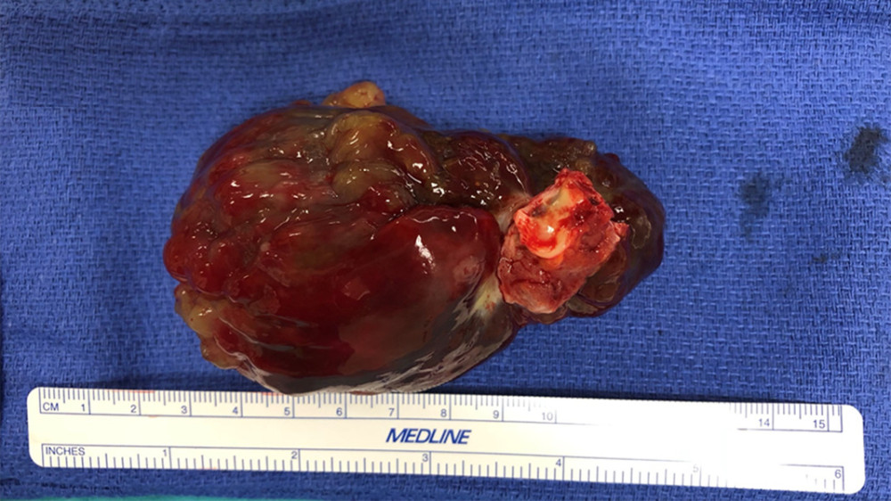 Postoperative image of pedunculated myxomatous tumor measuring 7.0×4.5×3.8 cm.
