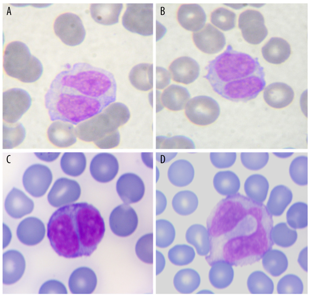 The peripheral blood smear film demonstrated medium- to large-sized atypical mature lymphocytes, with abundant faintly basophilic cytoplasm and characteristic nuclei demonstrating a rounded or more commonly irregular nuclei (ie, bilobated or binucleated), which are typical in patients with PPBL; A and C show bilobated lymphocytes, B demonstrates a binucleated lymphocyte, and D shows a lymphocyte with irregular bilobated nucleus, (images, May-Grünwald-Giemsa staining, ×100 objective, Carl Zeiss Microscopy GmbH, AxioCam 105 color).