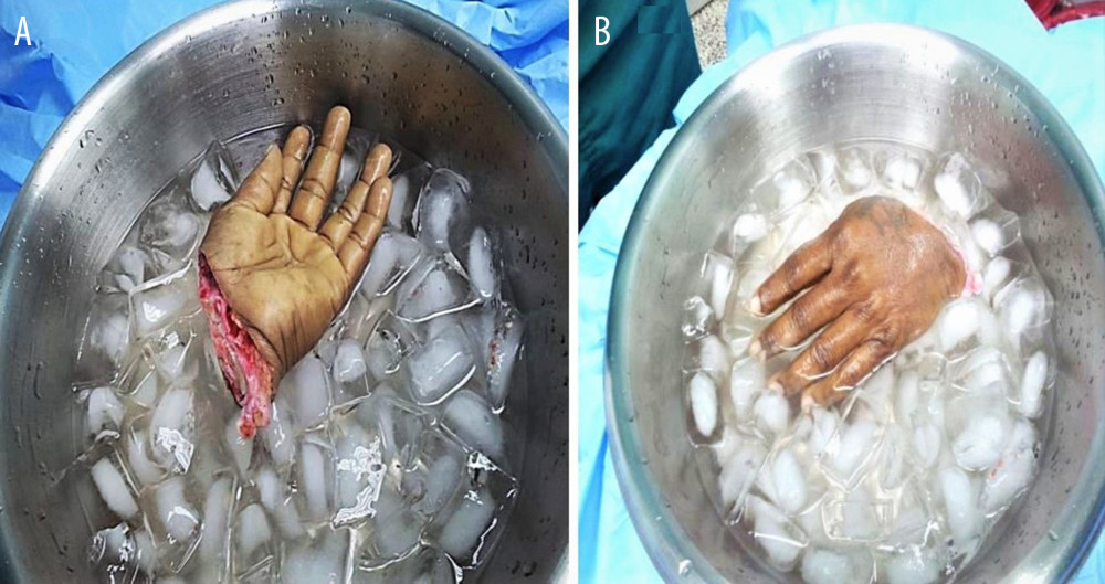 Amputated left hand in ice bowl (A) palmar view (B) dorsal view.