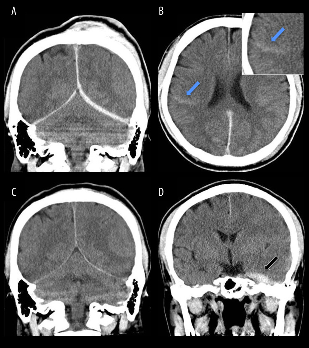 Coronal computed tomography (CT) shows subdural hematoma (SDH) at the left cerebellar tentorium (A) and falx accompanied by subarachnoid hemorrhage (blue arrow) in the right parietal lobe sulcus (B). Twelve days after head injury, CT shows that SDH on the cerebellar tentorium and falx has disappeared (C). Three weeks after injury, CT shows a de novo thickened SDH (black arrow) at the left cerebellar tentorium (D).