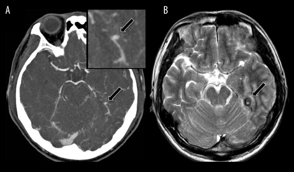 Computed tomography angiography shows a spot sign (arrow) close to the left quadrigeminal cistern (A). T2-weighted magnetic resonance imaging demonstrates a prominent circular hypointensity (arrow) at the cerebellar tentorium (B).