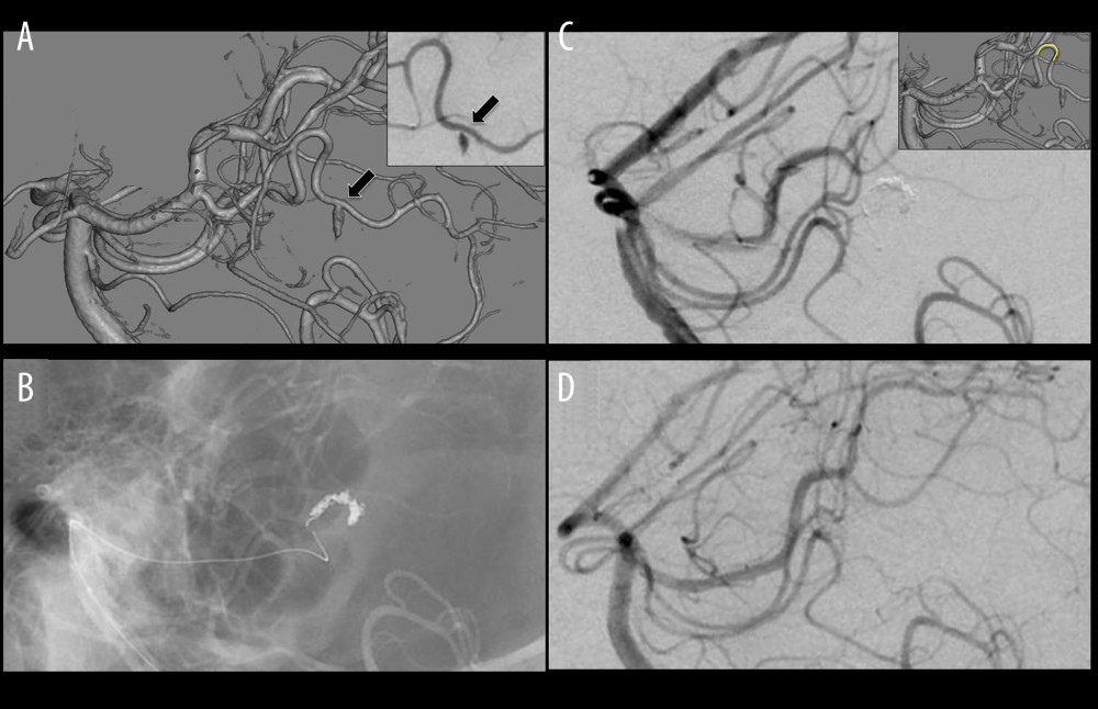Three-dimensional digital subtraction angiography and left vertebral artery angiography (VAG) in the late phase demonstrates peripheral posterior cerebral artery aneurysm (arrow), including absence of a clear neck, irregular contours, and delayed filling and emptying of the aneurysm (A). The fluoroscopic view (B) and left VAG (C) show the parent artery occluded by 5 coils. Left VAG 2 years after embolization demonstrates complete occlusion without recanalization (D). Picture-in-picture in (C): The yellow curve shows the area of coil embolization.