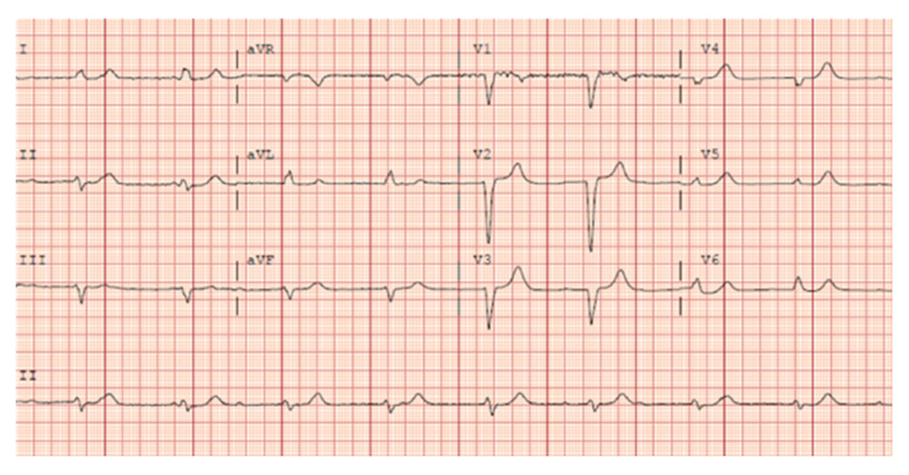 The patient’s admission electrocardiogram, taken in the Emergency Department, demonstrating third-degree heart block with atrioventricular dissociation and wide QRS complexes.