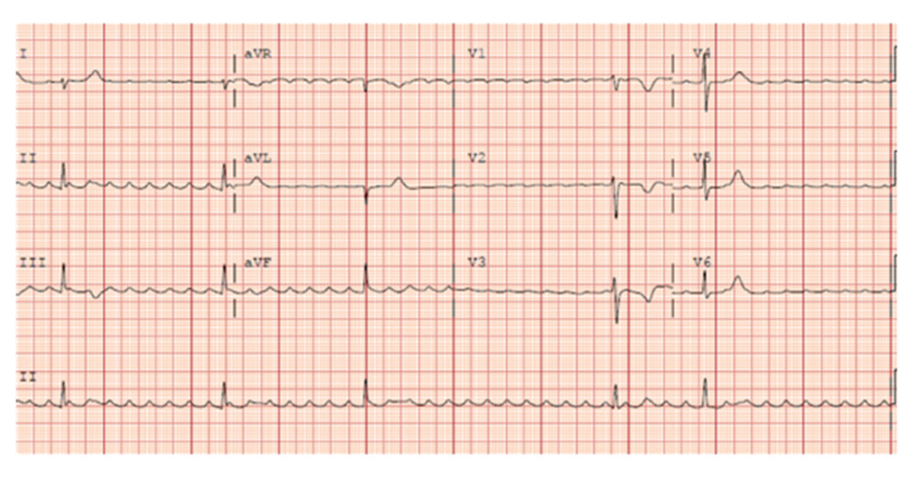The patient’s electrocardiogram on arrival to the Coronary Care Unit, suggestive of a reverse typical right-sided atrial flutter with slow ventricular response and variable conduction blockade, demonstrating T-wave inversions in V1–V3.