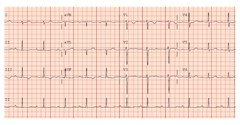 The patient’s electrocardiogram after synchronized electrical cardioversion, demonstrating restoration of normal sinus rhythm with first-degree atrioventricular block